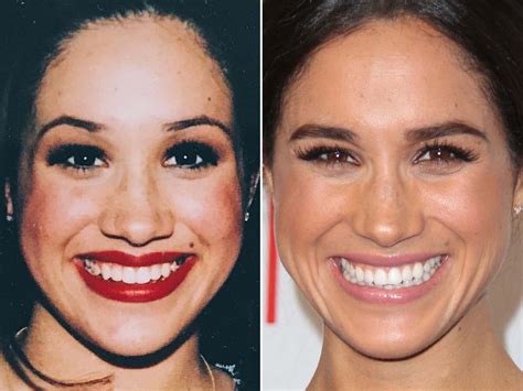 meghan markle nose job|Meghan Markles Nose Inspires Plastic Surgery Trends